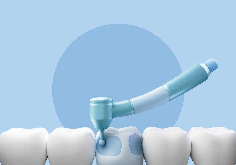 Ilustración 3D de tratamiento dental en un diente